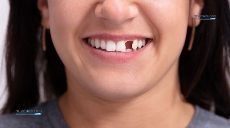 What Are the Options for a Missing Tooth?