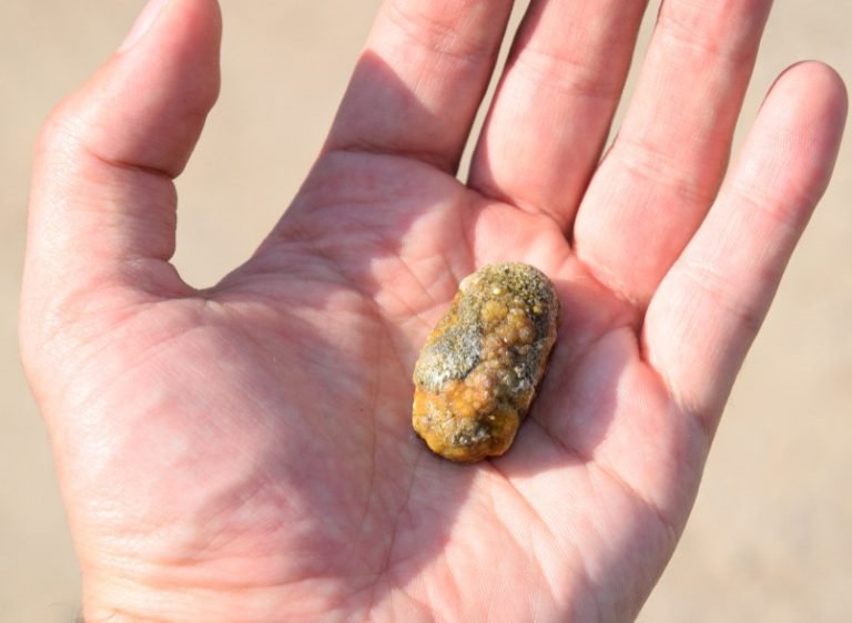 gallstones