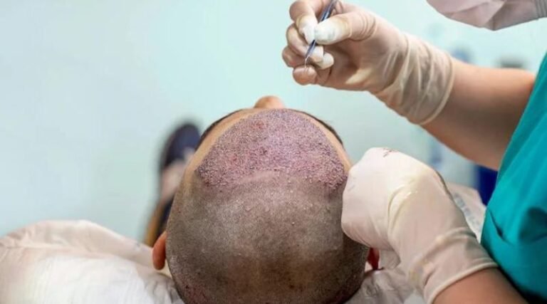Some Interesting Things To Know About The Hair Transplant Process