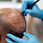 Hair Transplant