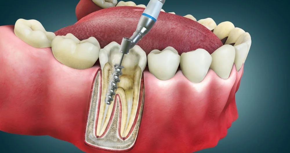 Root Canals