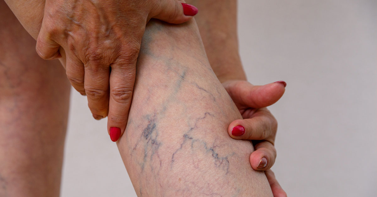 Vascular Veins