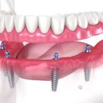 Dental Implants