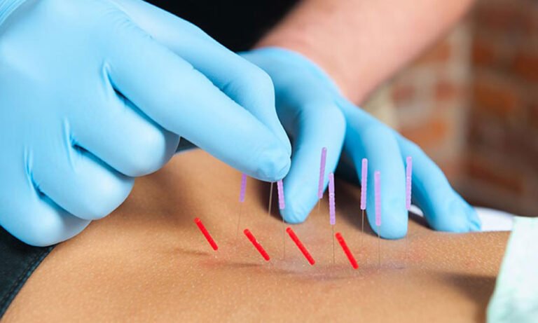 Physical Therapy Dry Needling