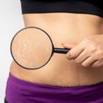 Stretch Mark Removal