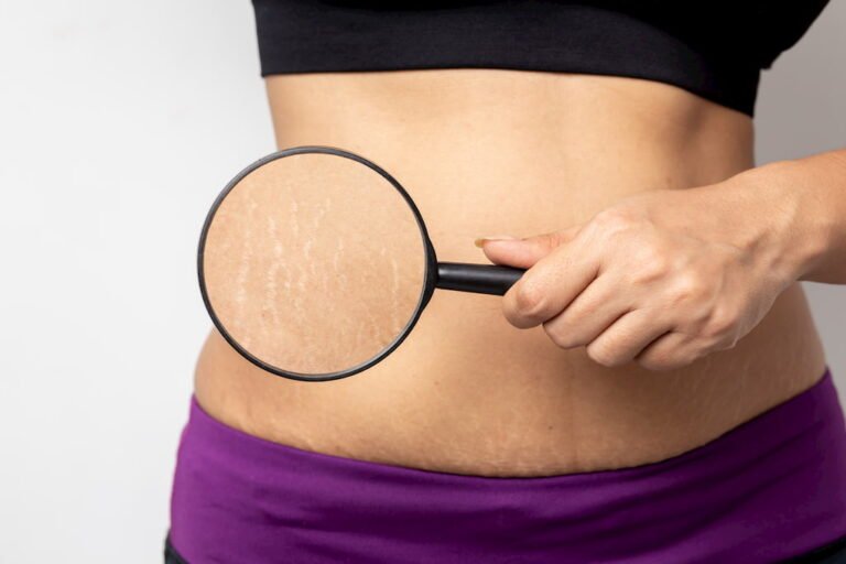 Stretch Mark Removal
