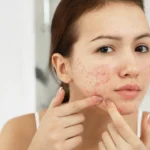 Fade Acne Scars