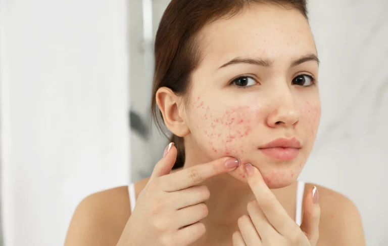 Fade Acne Scars