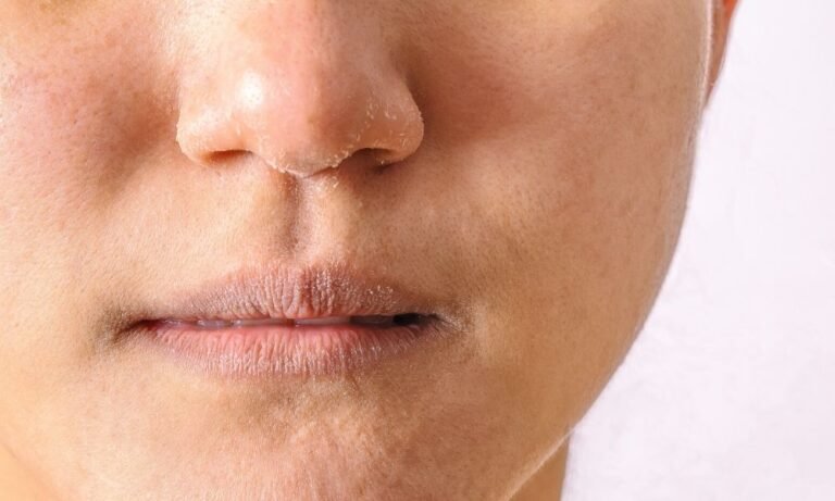 Relieve a Dry Nose