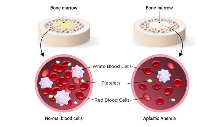 Aplastic Anemia