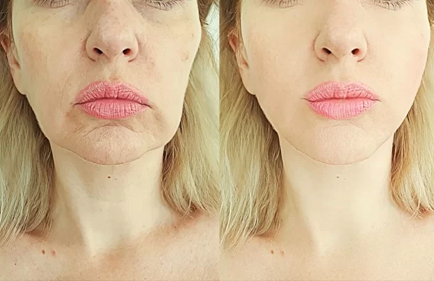 Non-Surgical Thread Lift